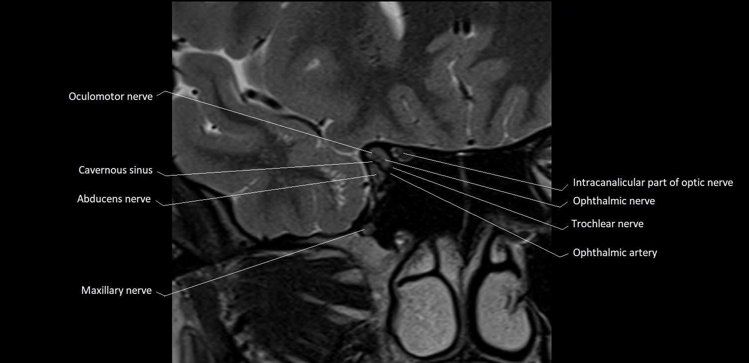 MRI Orbit coronal cross sectional anatomy image 17.webp